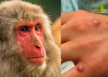 OBSH-ja konsideron shpalljen e lisë së majmunëve, një “emergjencë globale”