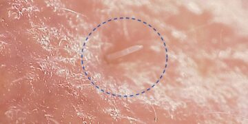 Merimangat mikroskopike që ndodhen në fytyrën tonë janë drejt zhdukjes