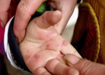 Çfarë është gripi i domates që po përhapet në Indi? Simptomat dhe trajtimi