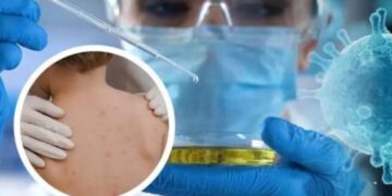 Në Serbi regjistrohen 31 raste me linë e majmunëve