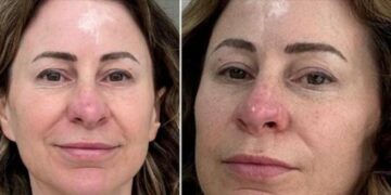 Habit 50-vjeçarja: Shita shtëpinë për të paguar operacionet e mia plastike, tani jetoj në një furgon