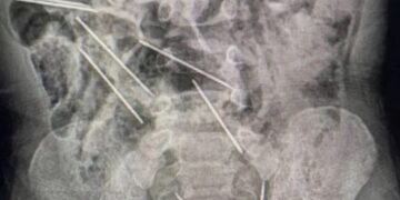 Ndodh mrekullia! Mjekët shpëtojnë 2-vjeçarin pasi gëlltiti tetë gjilpëra