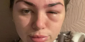 Shkoi për të rregulluar vetullat, 28-vjeçarja rrezikon të humbasë shikimin