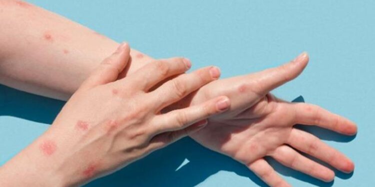 Konfirmohen dy raste të lisë së majmunit në shtetin fqinj, autoritetet thirrje për masa