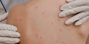 Alarm në SHBA, fruthi ‘shpërthen’ në disa shtete/ Mjekët: Njerëzit nuk po vaksinohen më