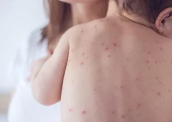 Alarm për fruthin/ Shpërthim infektimesh në një kopsht në kryeqytet, 15 fëmijë të prekur