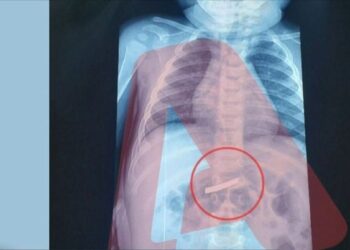 E frikshme! 3-vjeçari gëlltit briskun e rrojes