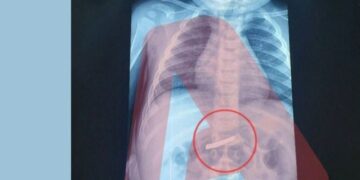 E frikshme! 3-vjeçari gëlltit briskun e rrojes